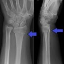 Collesfracture