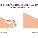 Diferencia_Dedo_Garra_y_Martillo@03x