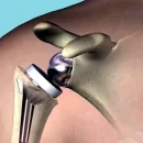 Reverse-Shoulder-Arthroplasty