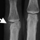 fractura-condilar-falange-1024x682