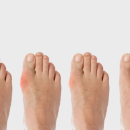 hallux-valgus-cirugia-juanetes