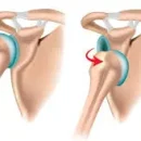 inestabilidad-de-hombro