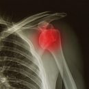 shoulder_dislocation_xray